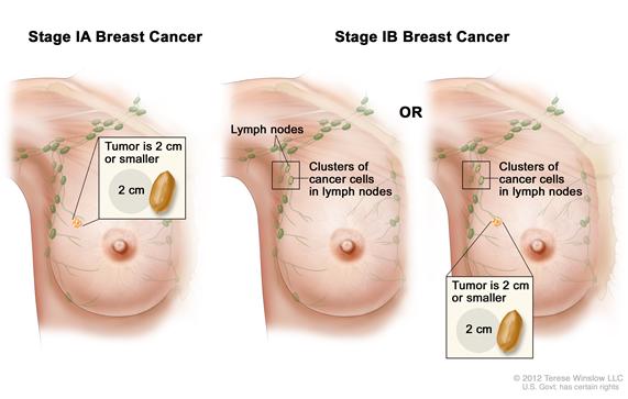 Hasil gambar untuk kanker payudara idc